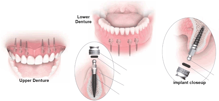 Dentures, upper denture, lower denture, maxillary denture, minis, mini implants, mandibular denture, anchor