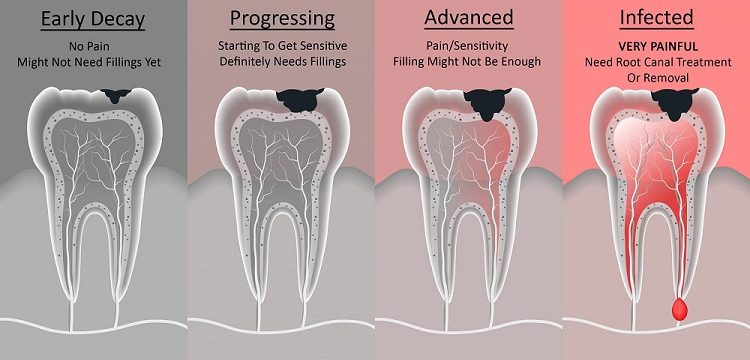 How to Repair Tooth Enamel, Amherst Dentist